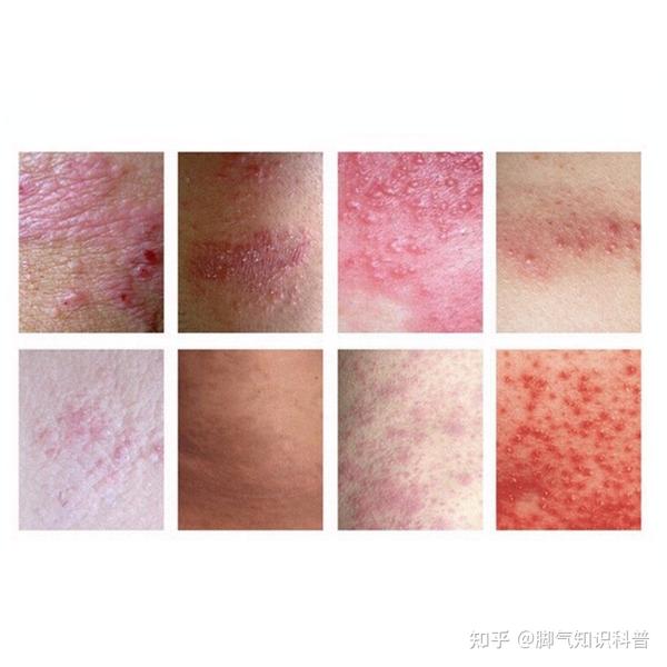 湿疹和脚气如何区分? - 知乎