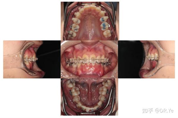失败正畸病例 一起学习过山车效应 知乎