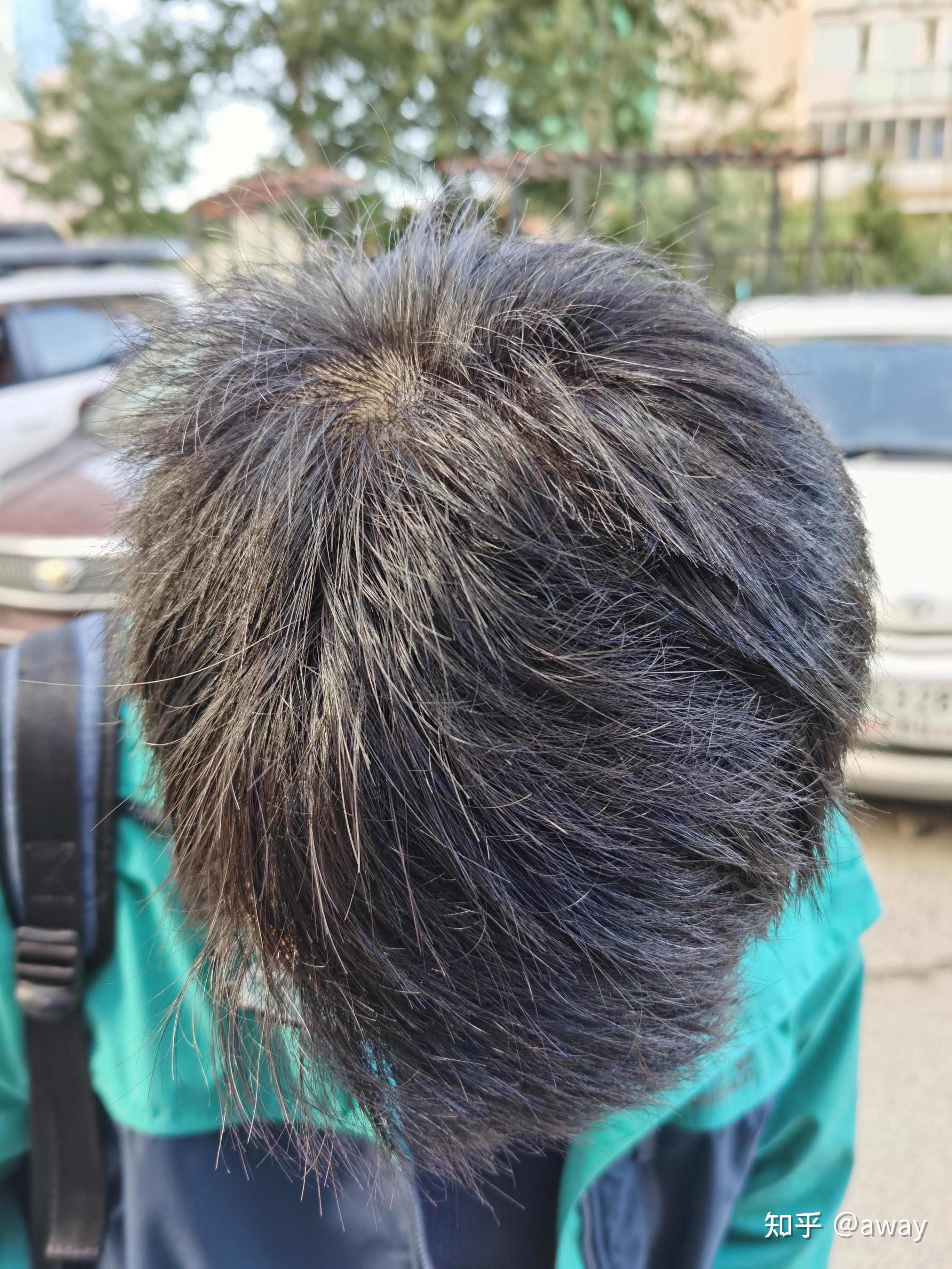 半年后的效果,头顶头发已恢复正常发量,并且发质黑且浓密