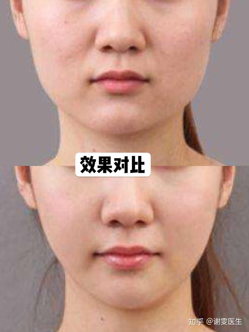 瘦脸针打多少钱_瘦脸针100单位价格_打一次瘦脸针价格表