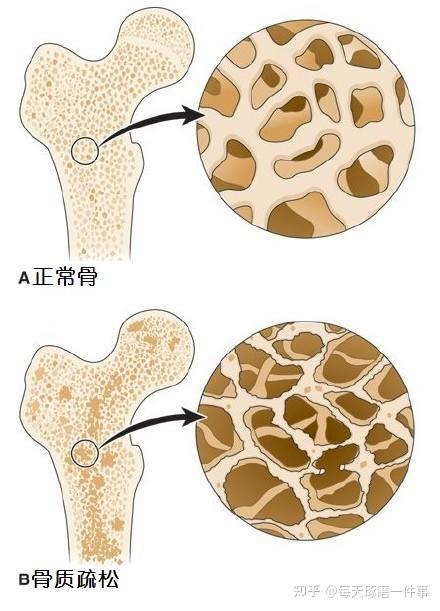 骨质疏松高危风险有哪些