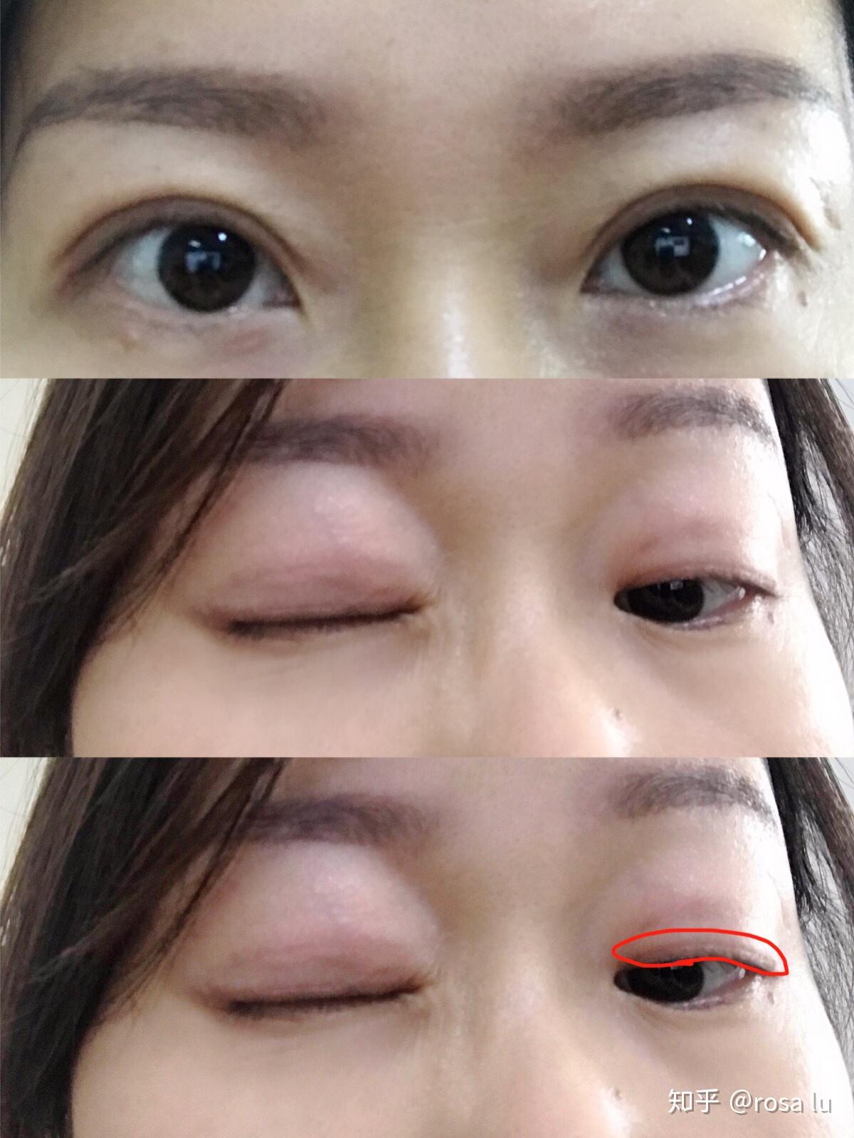无痕全切双眼皮手术恢复情况分享简单粗暴全是照片