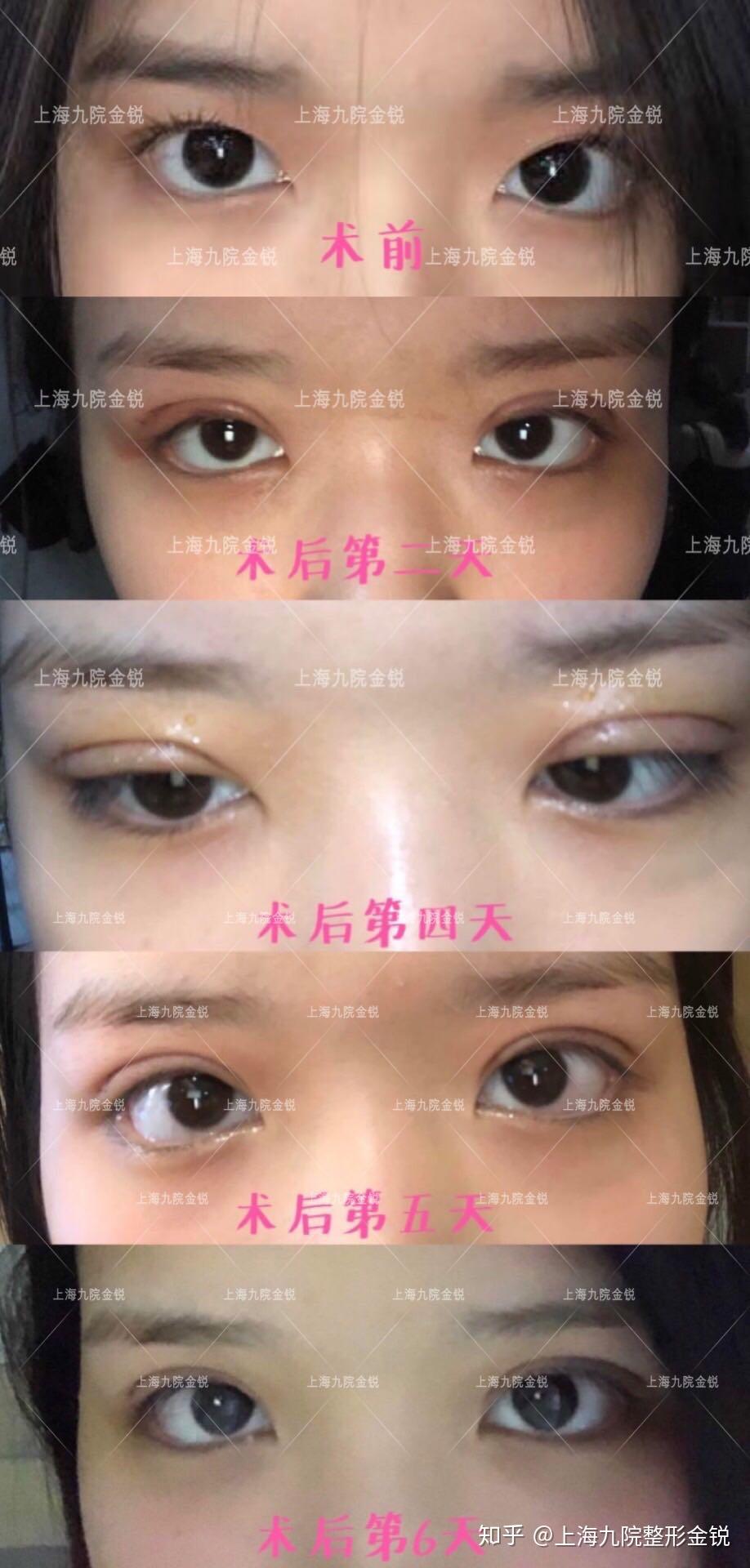 上海九院金锐双眼皮案例