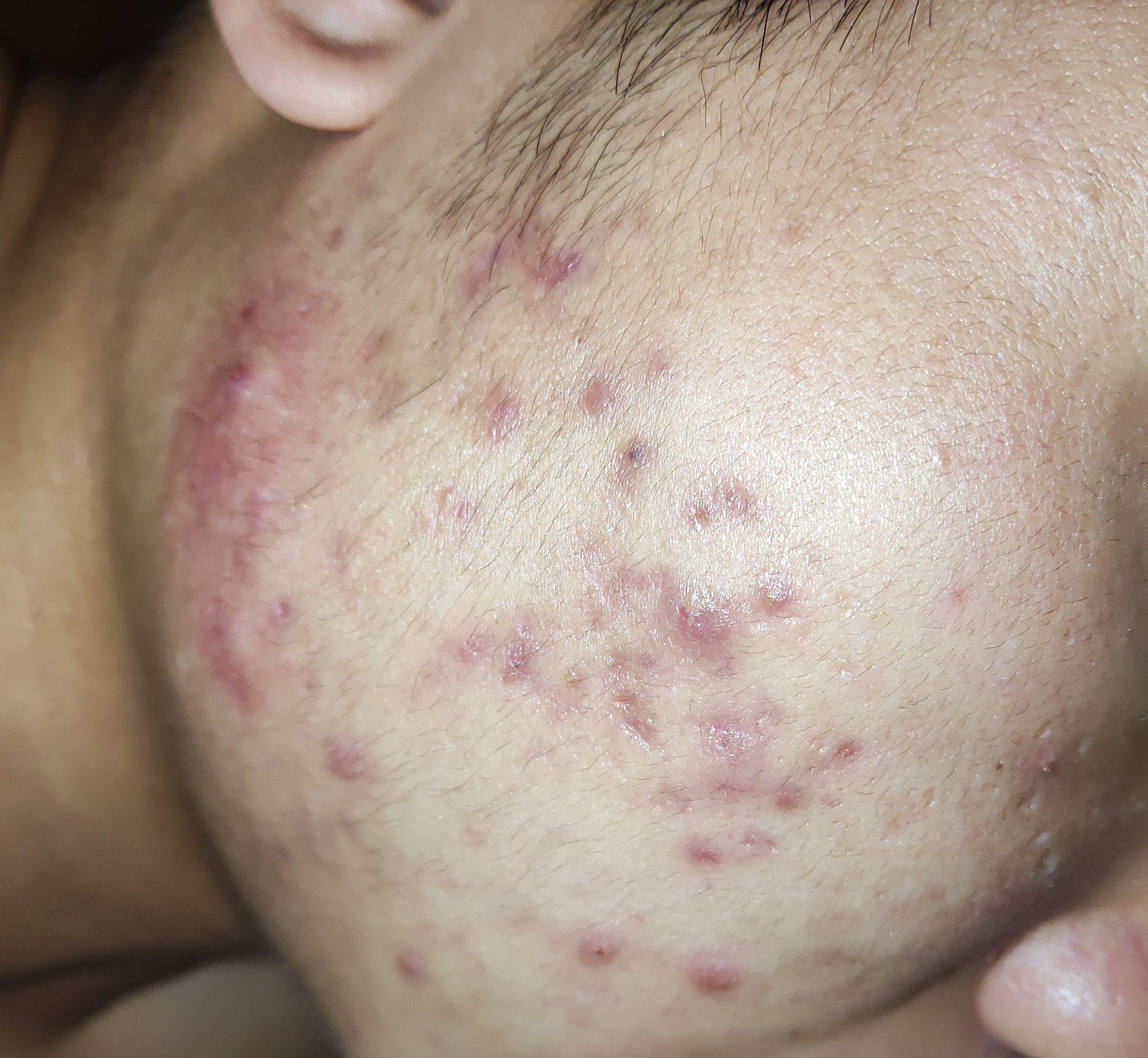 脸上很多痘印怎么办(⊙o⊙)! - 知乎