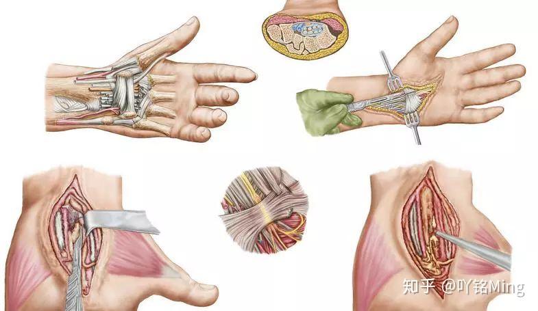 jospt科普专栏——腕管综合征保守治疗能否代替手术?