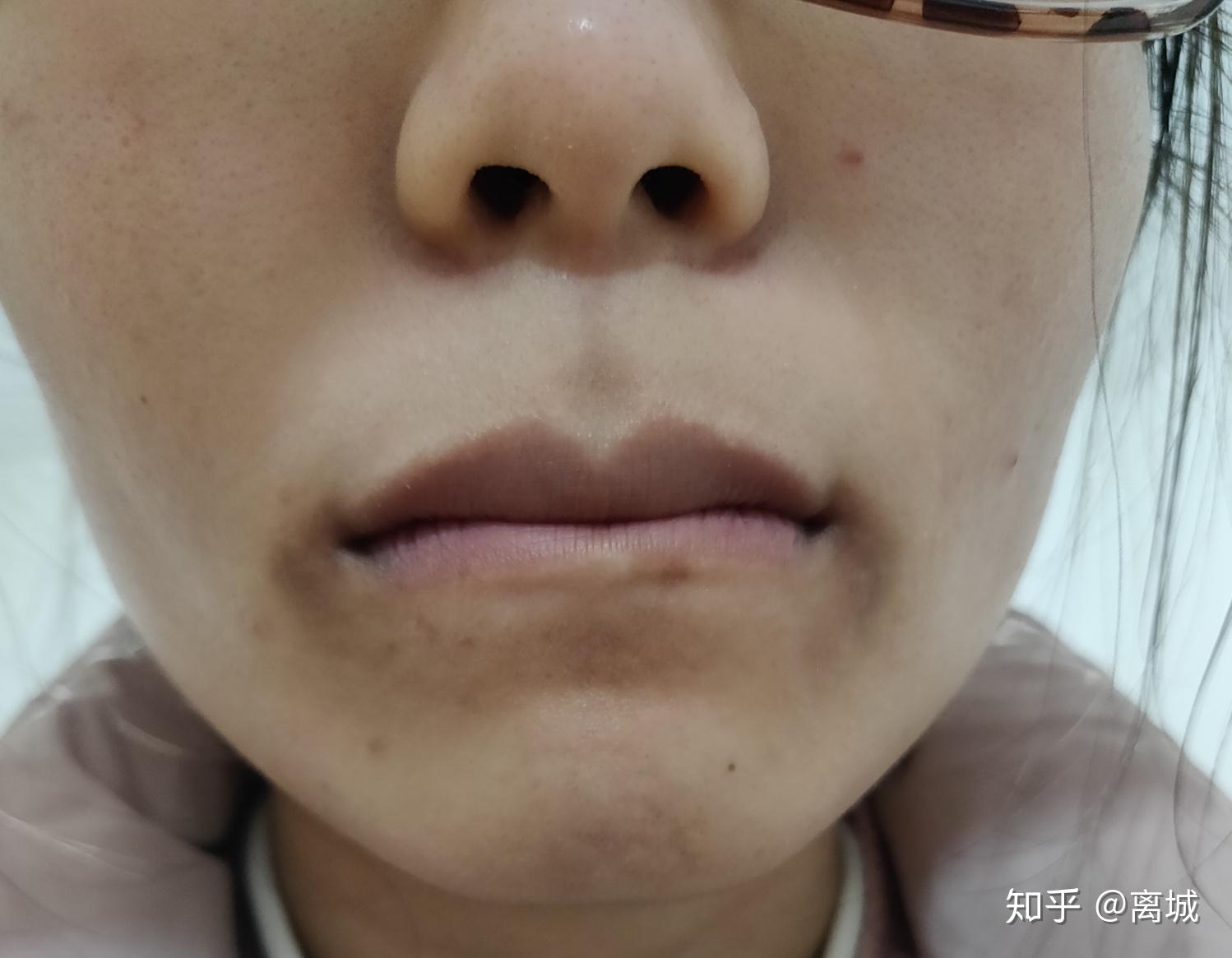 维a酸乳膏记录贴