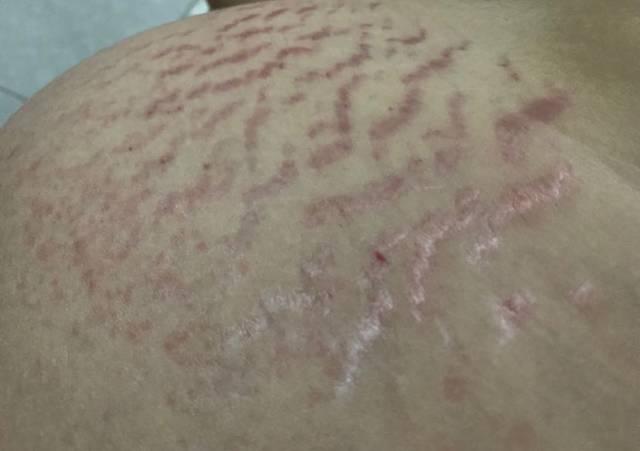 哺乳期妊娠纹痒得厉害怎么办 妊娠纹痒怎么缓解