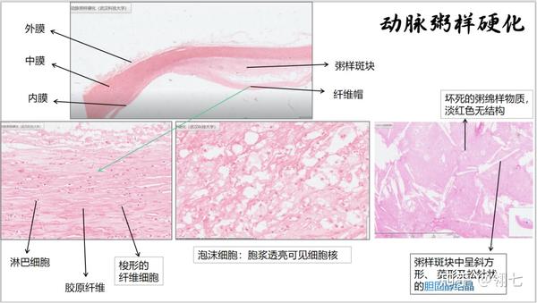 病理学实验报告 心血管系统 - 知乎