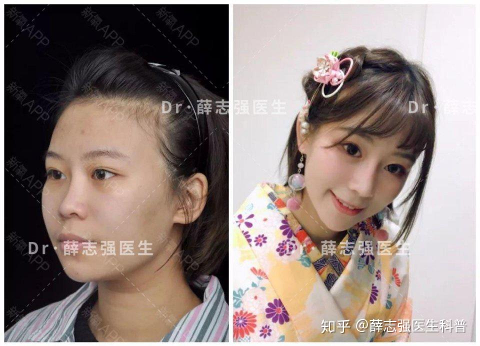 鼻修复的人越来越多,到底该怎么做才能减少鼻修复的次数? - 知乎