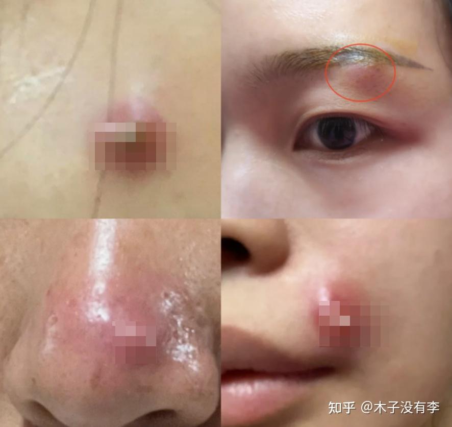 为什么脸上经常爆痘,那种大的火疖子,按着还疼,中间有黄白点!有没有医学生专用的祛痘(火疖子)秘诀分享下?? - 知乎
