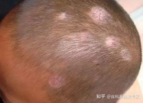 盘点与斑秃相似的脱发类型