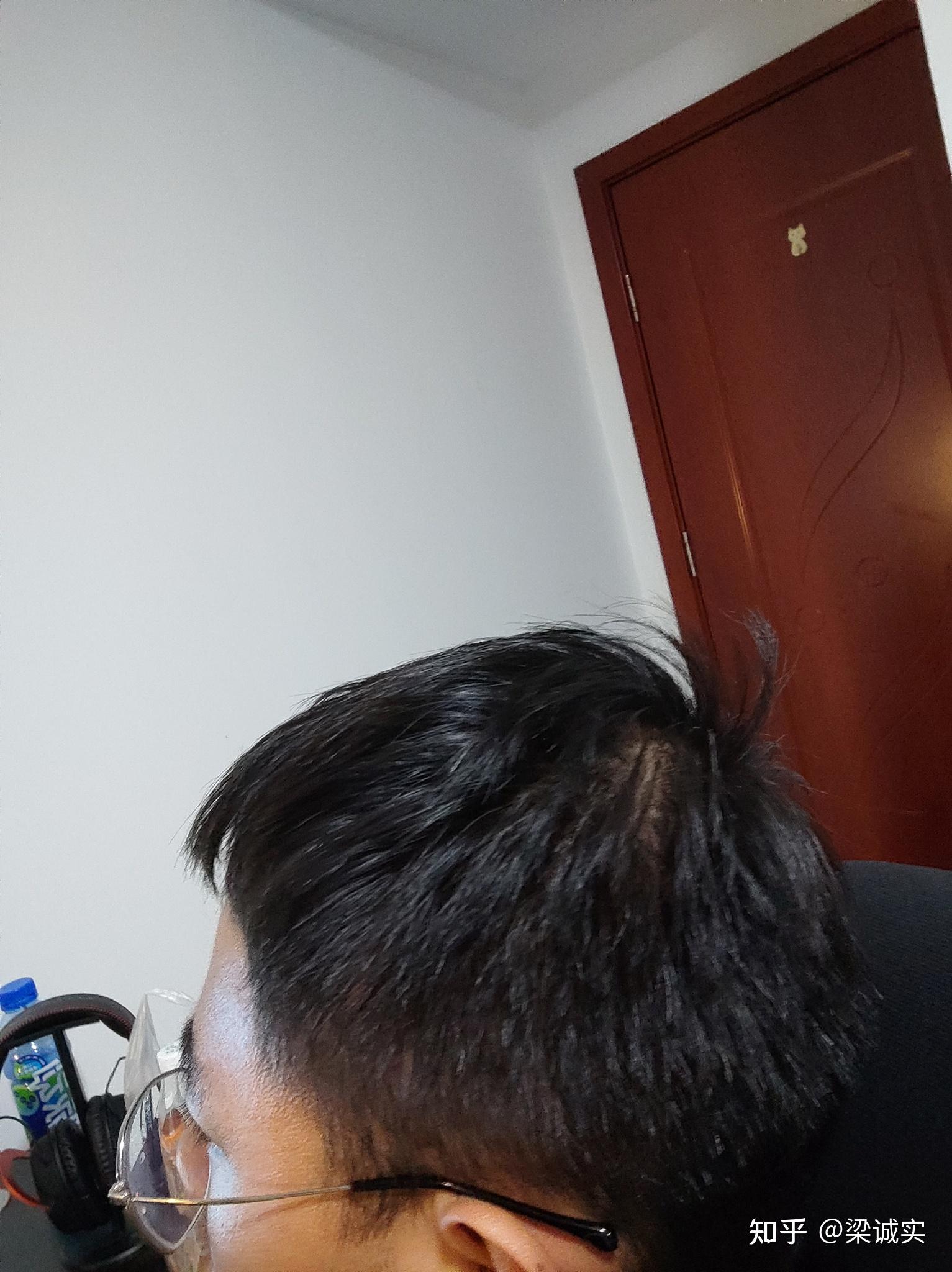 两个旋头顶炸一撮毛好难受啊,怎么办? - 知乎