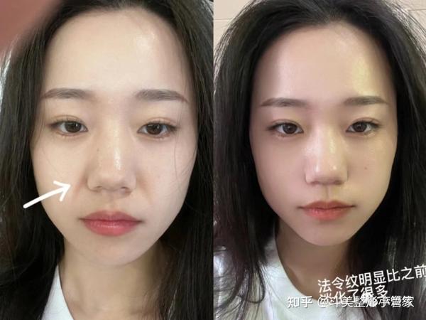 如何改善面部的法令纹有哪些方法值得分享