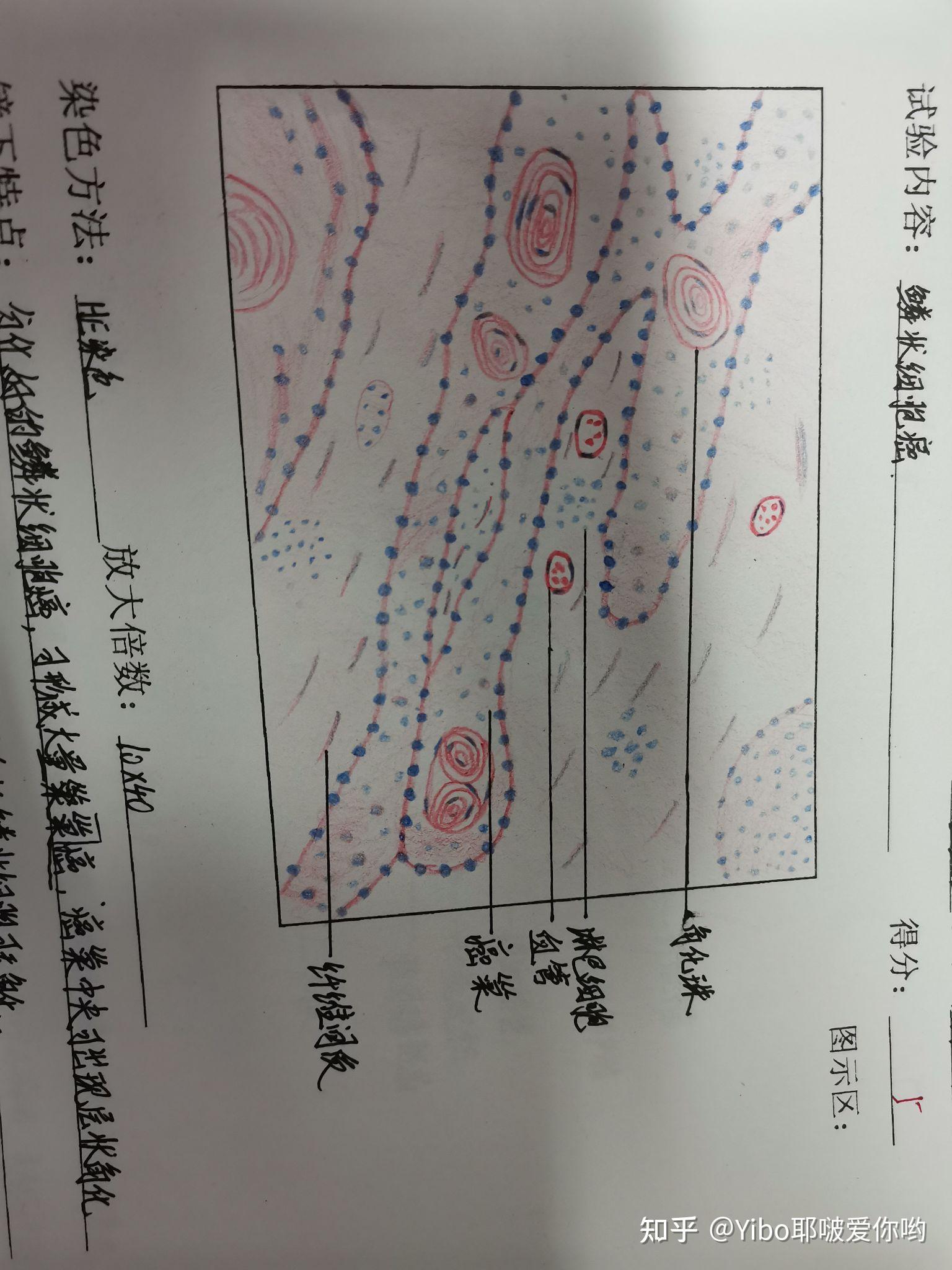 平滑肌肉瘤红蓝铅笔图图片
