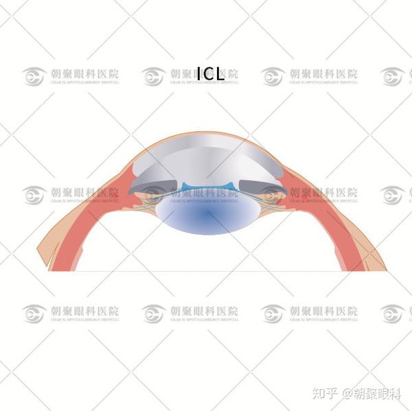Icl晶体植入术后注意事项 Icl晶体只有年寿命 Icl晶体千万不要做