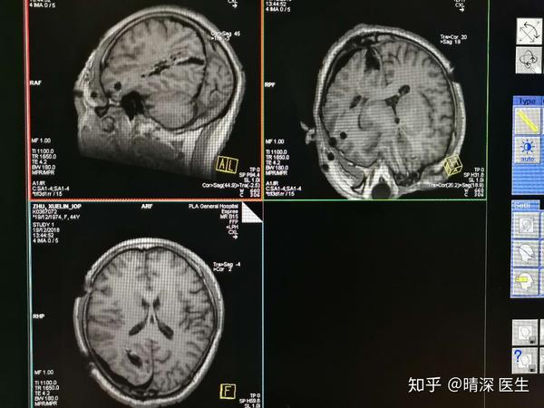 Mri Mrs Mra是什么检查 医学mrs是什么检查 桃丽网