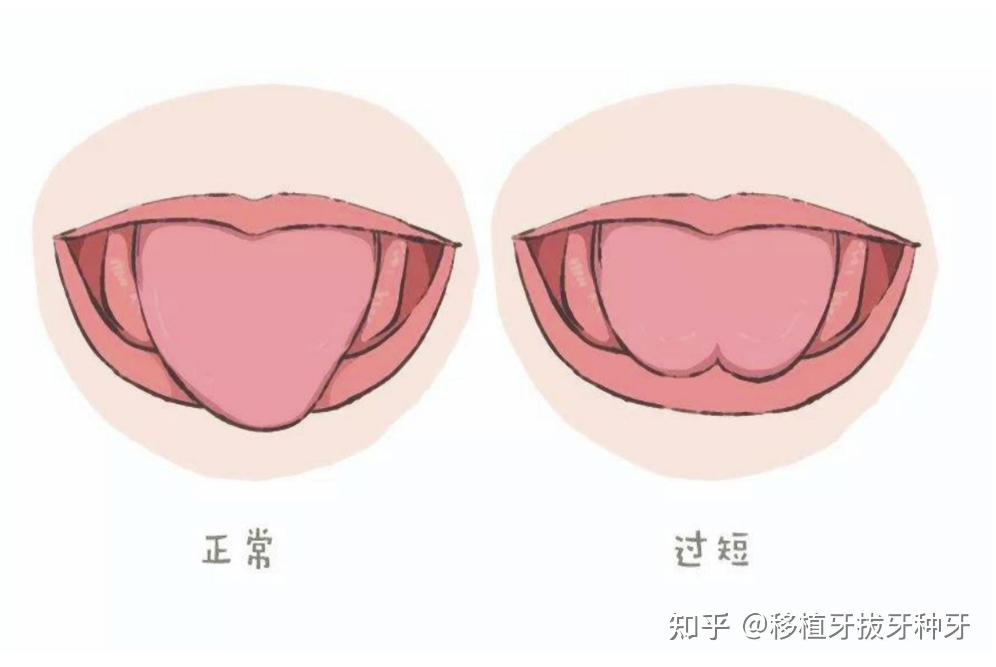 系带成形术示意图图片