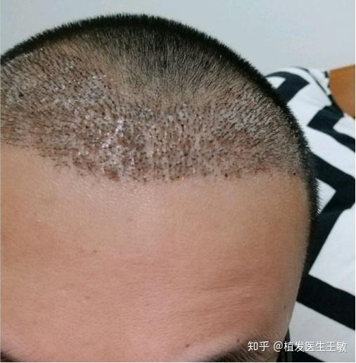 "鲁尼植发后又秃了,你居然还相信植发效果永久不脱落"