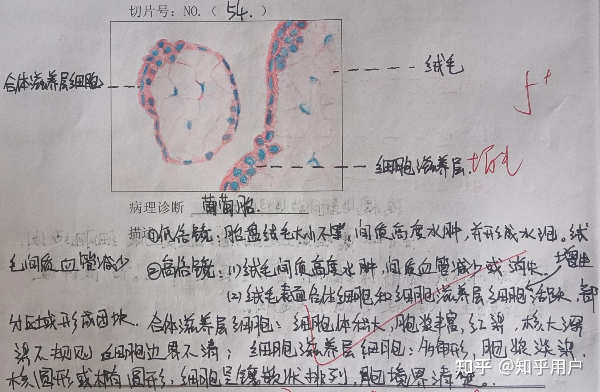 流行性乙型脑炎手绘图图片