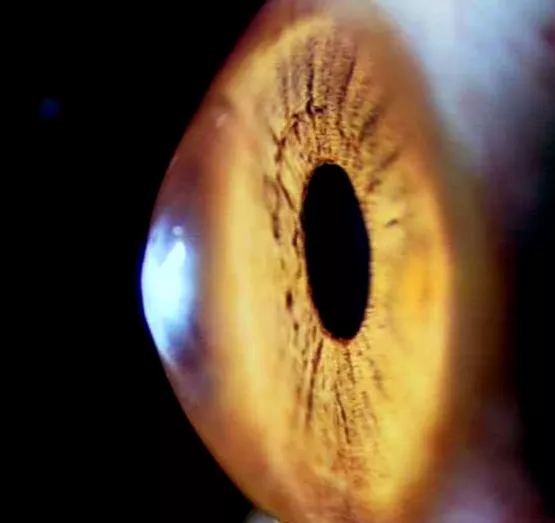 视力杀手圆锥角膜病有哪些诱因?又有哪些方法可以治疗呢?