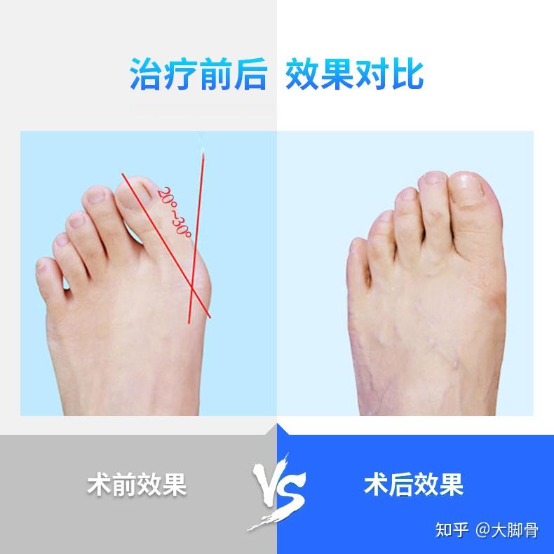 北京丰台广济医院科普：重视拇外翻，呵护脚部健康 - 知乎