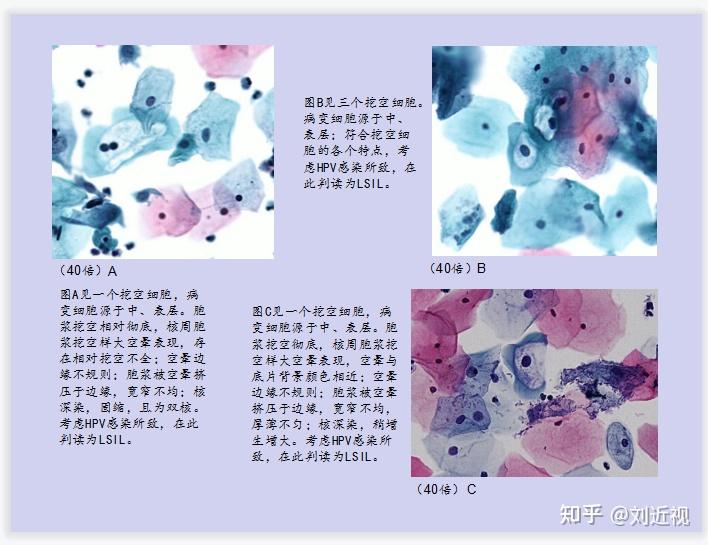 宫颈细胞学课件(部分) - 知乎