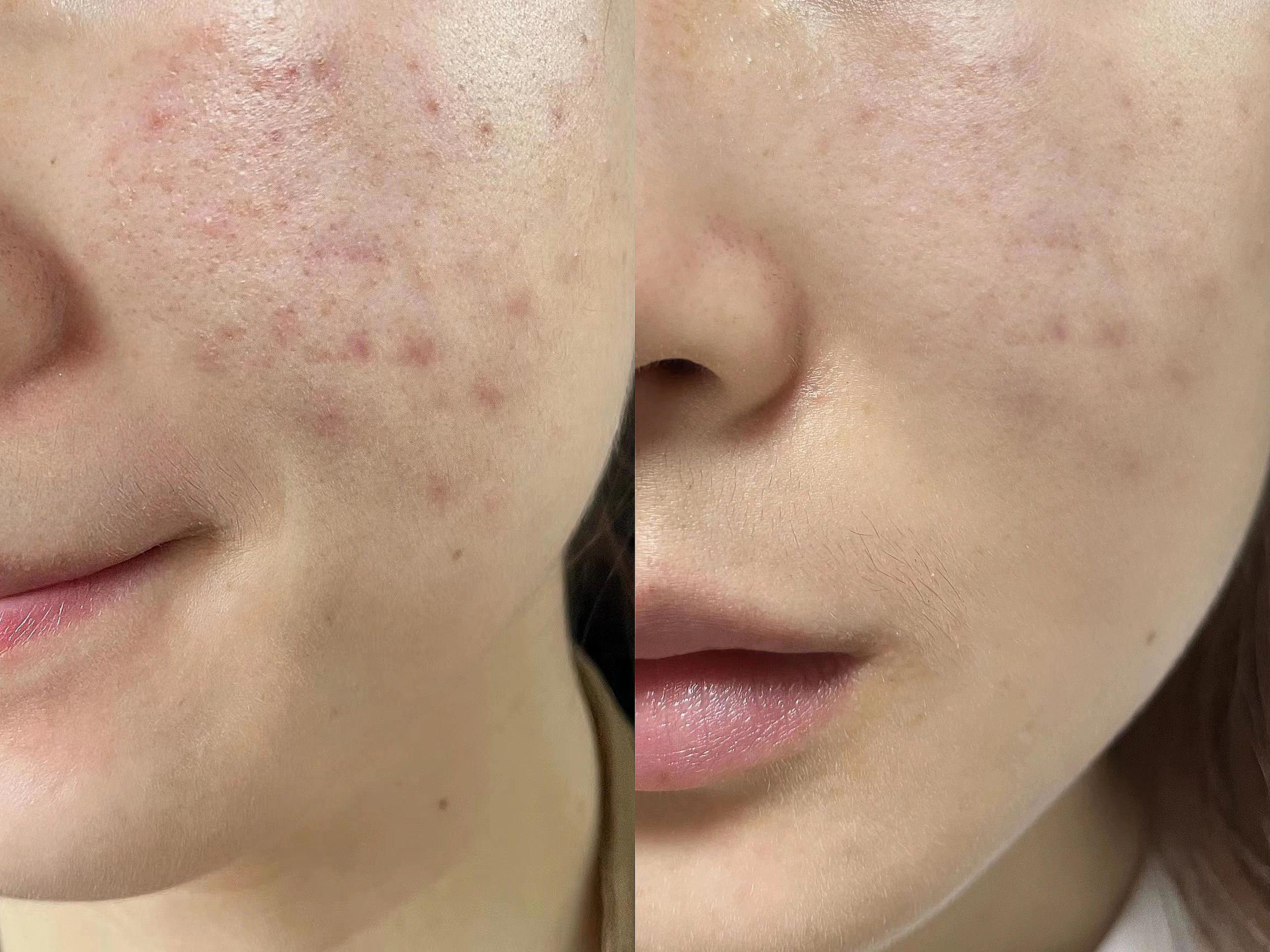 一个月就能拥有奶油肌,拒绝油腻脸蛋! - 知乎