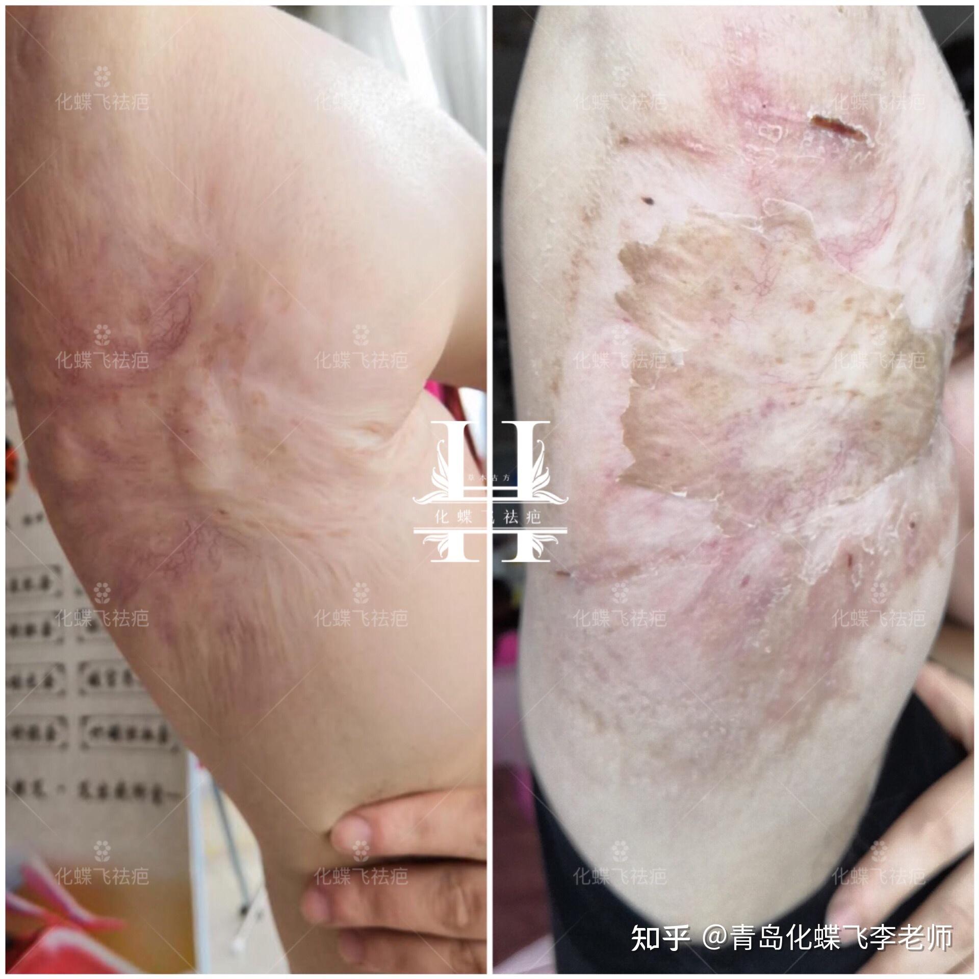 30年陈旧性烫伤疤痕修复