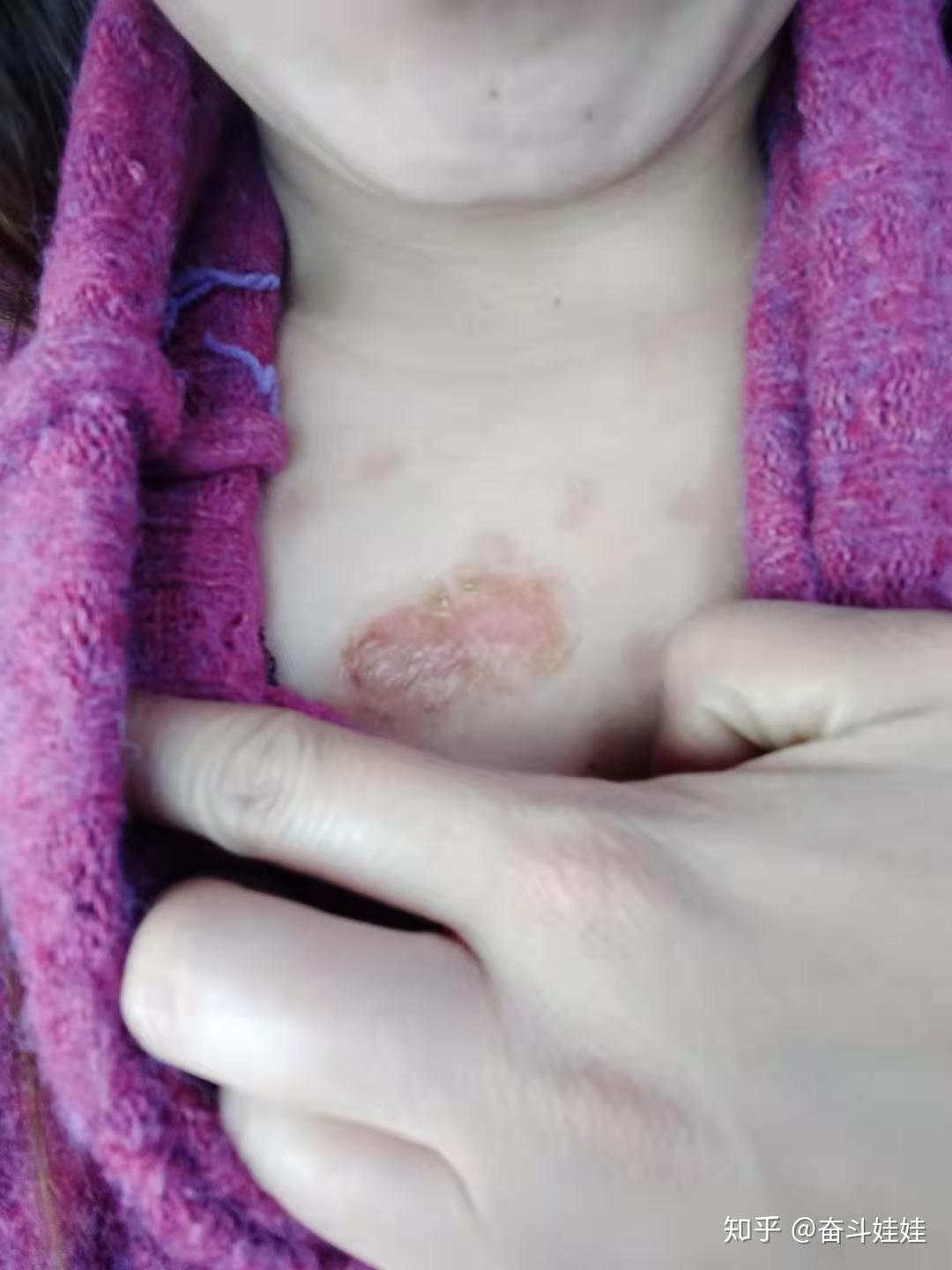 十多年的疤痕疙瘩脱皮结痂中