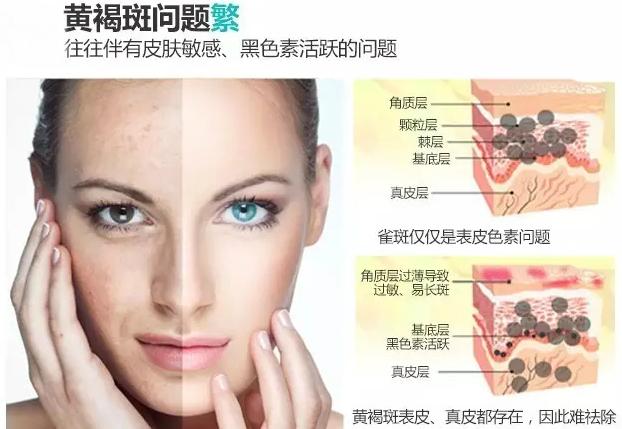 超皮秒祛黄褐斑一般几次可以干净