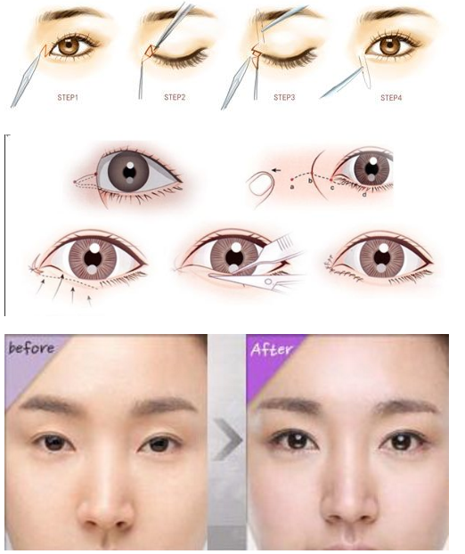 开眼角可以解决眼睛小眼间距的问题吗