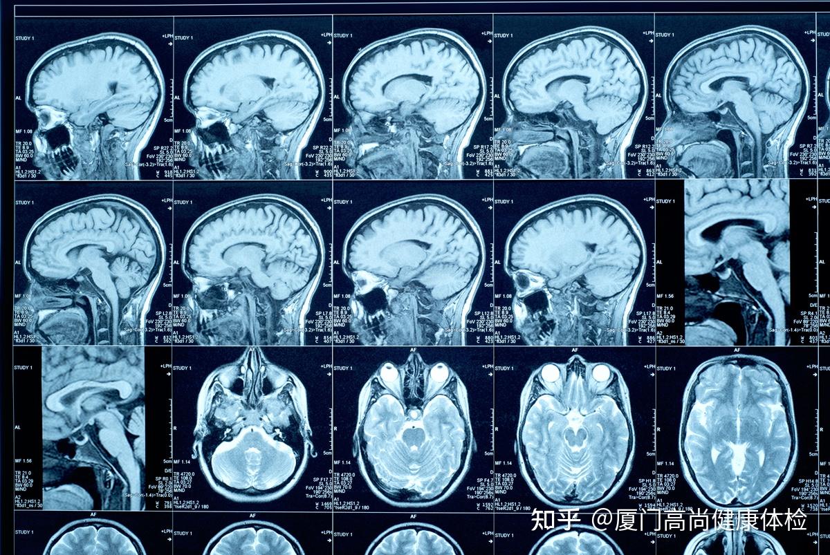 【高尚健康】脑部体检选择指南:头颅CT与头颅磁共振如何选? - 知乎