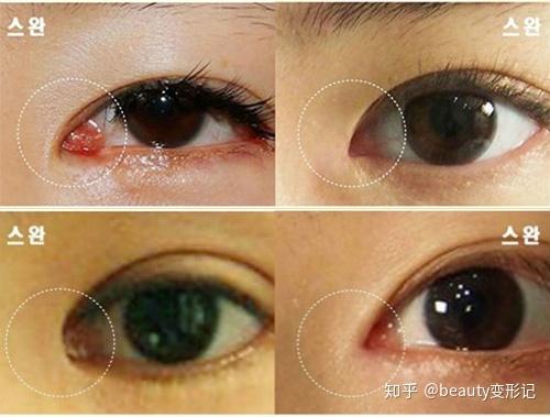 内眼角回包修复过程分几步为什么有医生说没修复余地