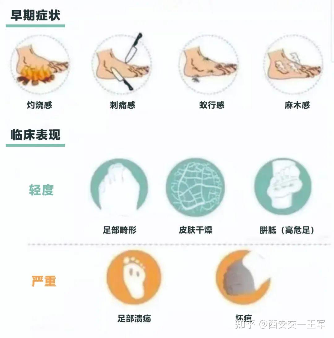 糖尿病患者由于足部神经病变