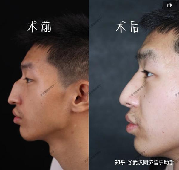 关于驼峰鼻整形你知道多少? - 知乎