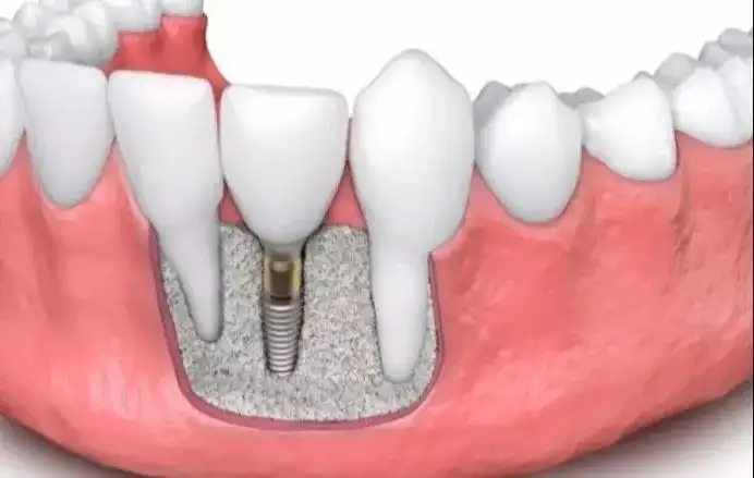 武汉种植牙医院有哪些?诺贝尔|iti|美国3i|奥齿泰等植体怎么选?种植牙
