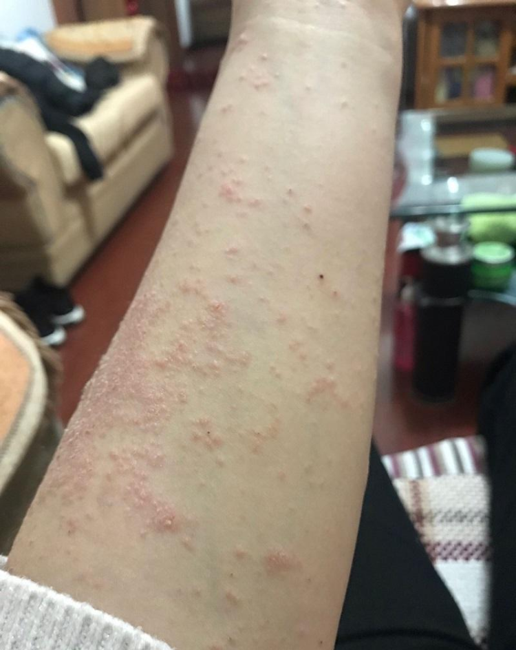 我是来终结这个问题的,让你彻底摆脱湿疹的困境!