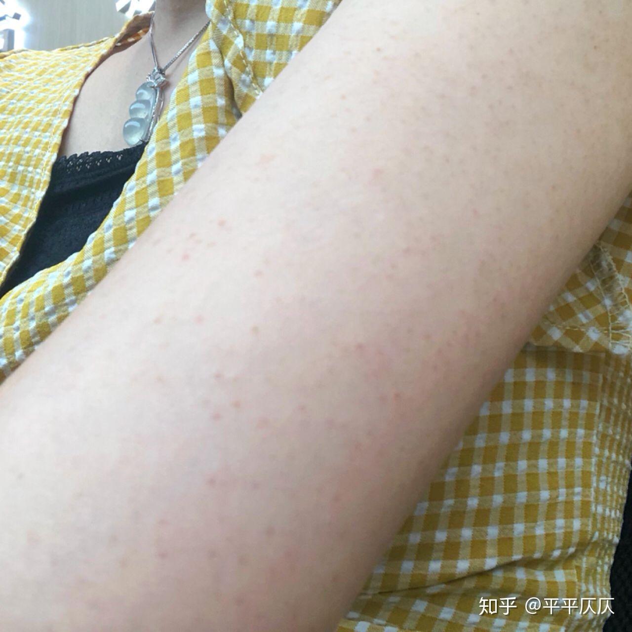 关于男朋友会介意严重鸡皮肤吗的信息