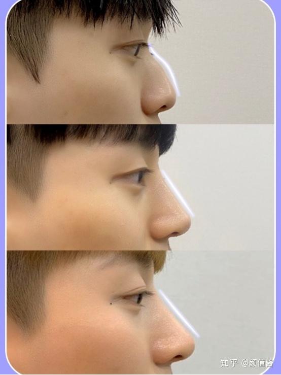 术前:典型驼峰鼻,侧看整个鼻部短小,山根低,线条也不好看,鼻基底略微