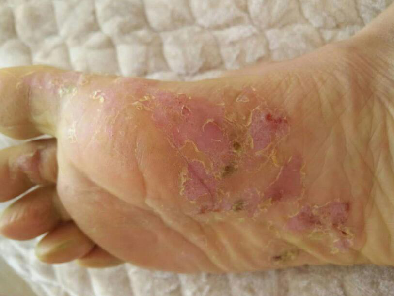 脚气喷剂排行榜 脚气用什么药好丨脚气喷剂十大品牌 知乎