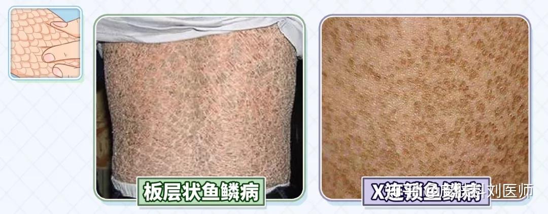 天气转凉,腿上的皮肤又开始干燥,脱皮?这就是"鱼鳞病"吗?