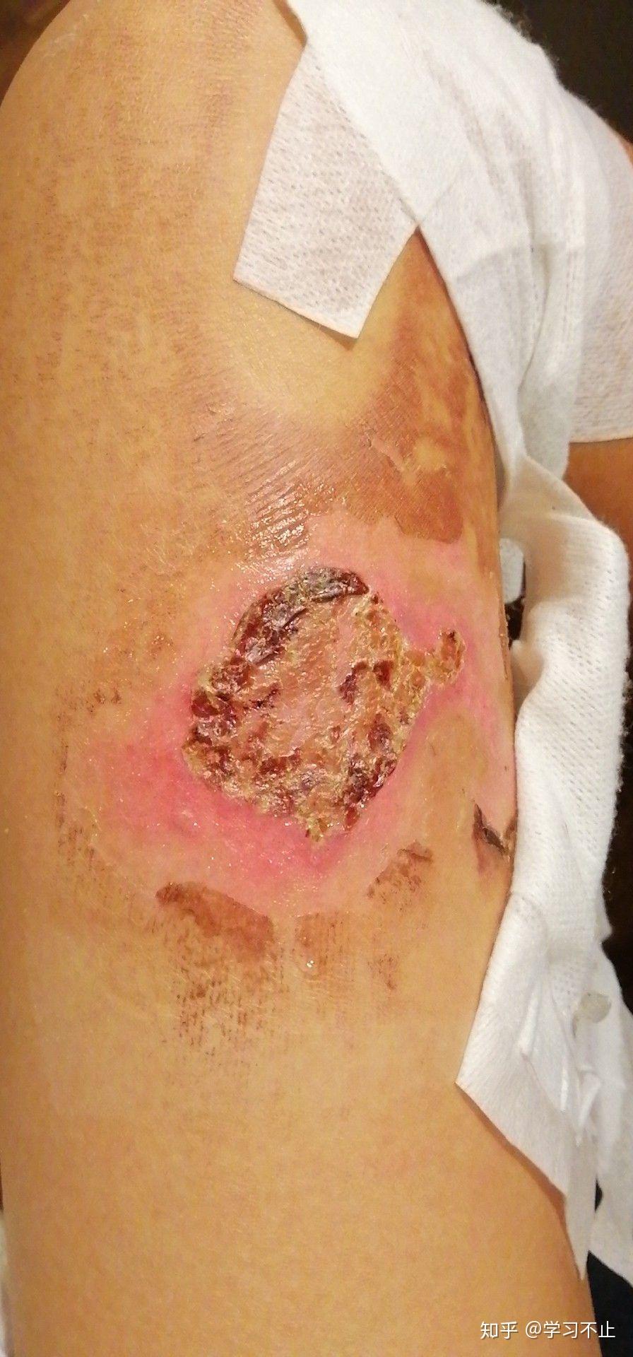 巴黎烫伤脱皮记