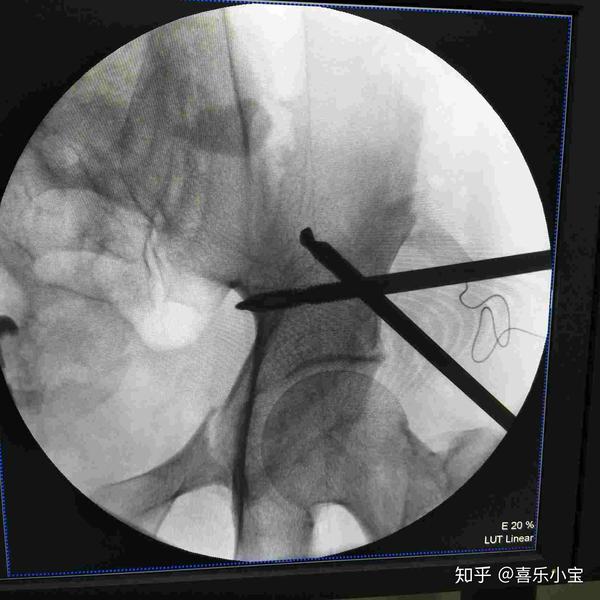 治疗陈旧性骨盆骨折临汾市中心医院实施微创手术 知乎