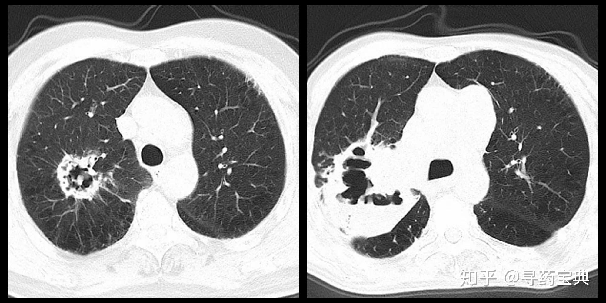 特发性肺纤维化 - NEJM医学前沿