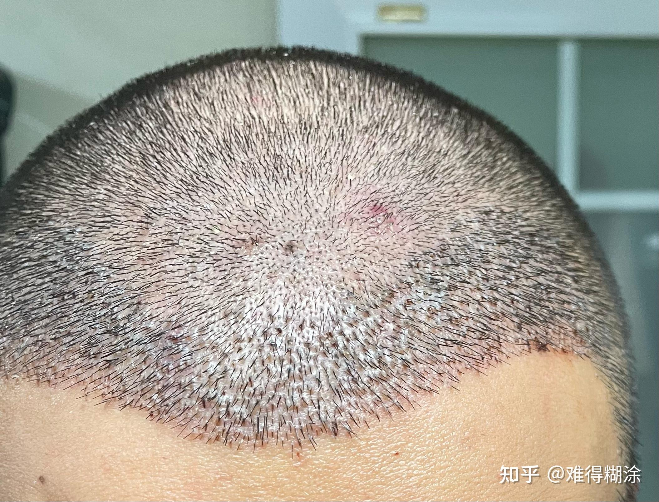 重庆雍禾植发，前后两次植发效果反馈， - 知乎