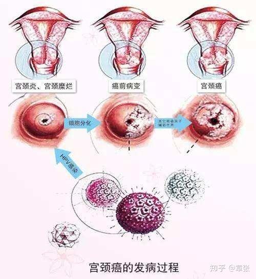 体检查出hpv阳性，是不是患上了宫颈癌？