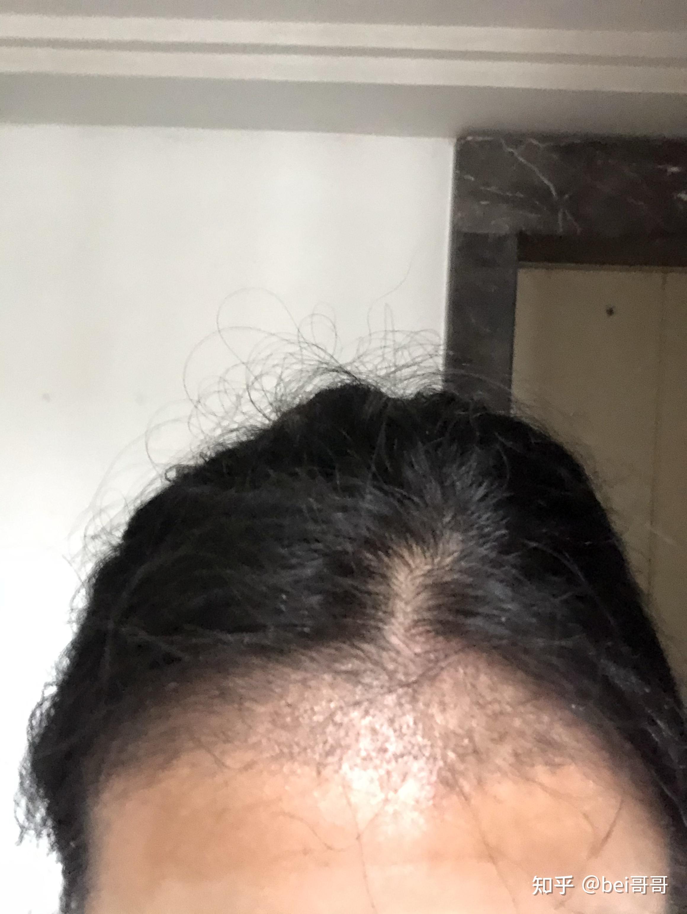 植发半年还红肿正常吗吗(植发半年后,效果不明显是怎么回事?)