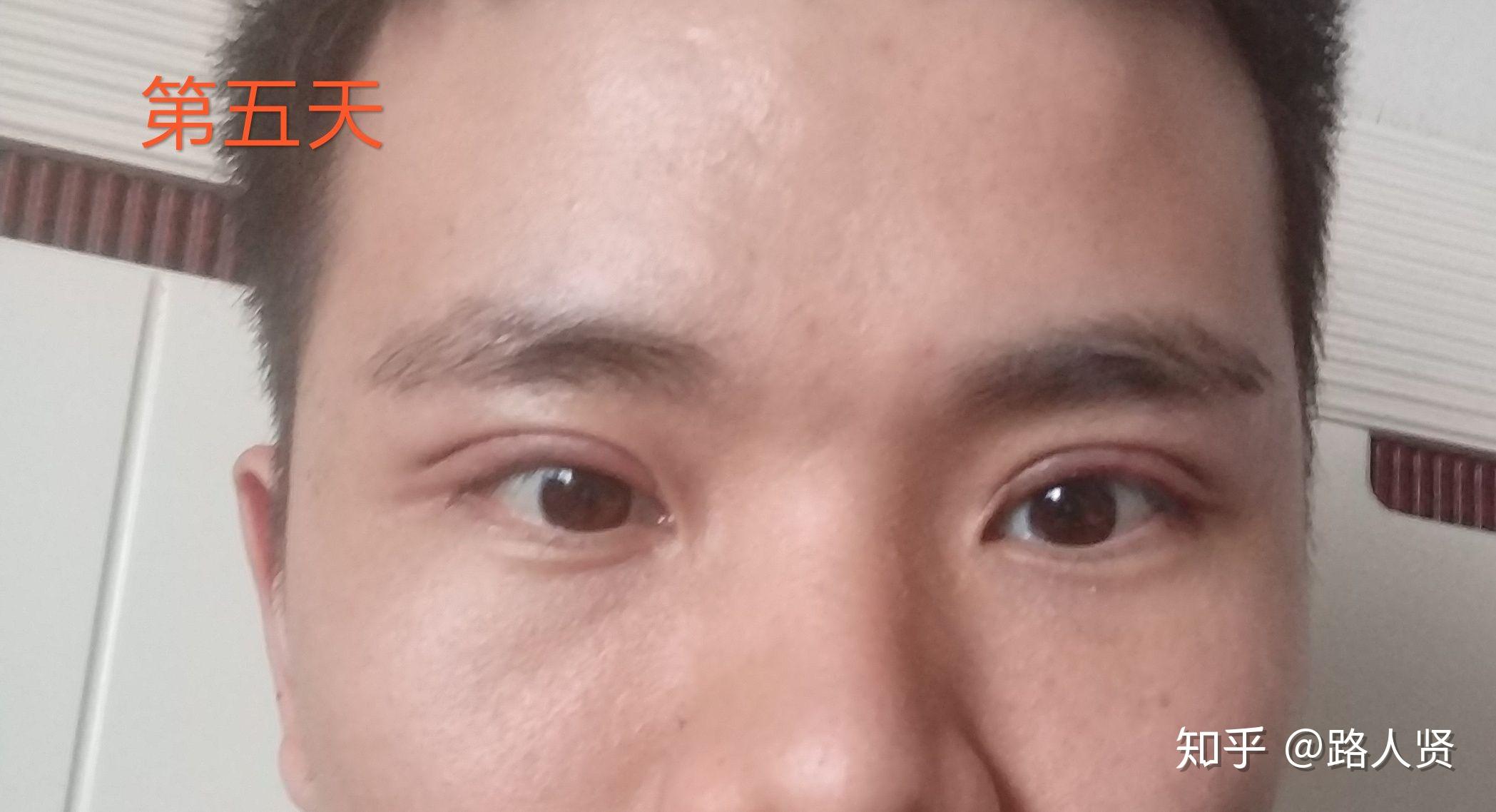 在深圳做的男生双眼皮，全过程记录！超级棒的深圳双眼皮 - 知乎