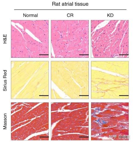 五,心脏纤维化是什么?