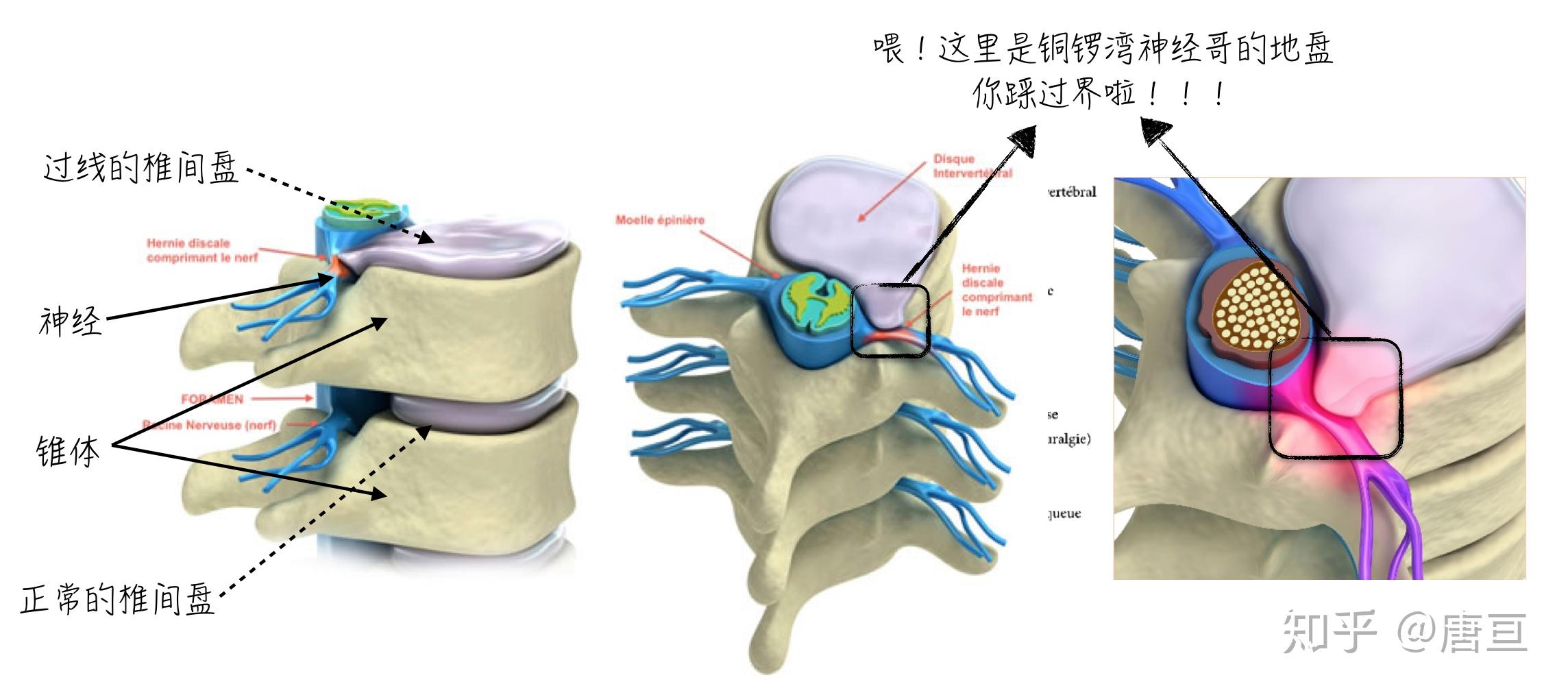 脊椎过伸固定支具-脊柱保护固定支架-安平县康博医疗器械有限公司